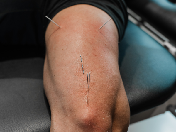 Dry Needling in elbow at Apex Physical Therapy and Sports Performance